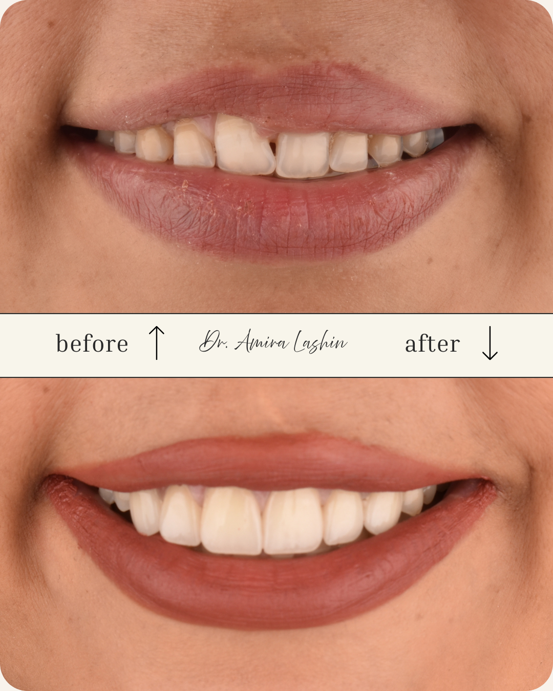 ابتسامة هوليود